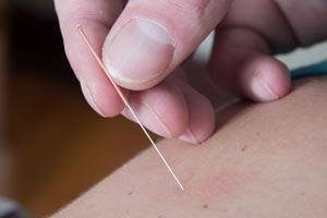 acupuncture needle into skin